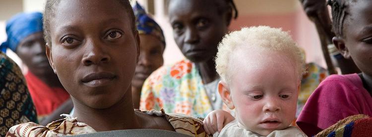 Photo: A caregiver attends to an abandoned toddler with albinism in Goma, North Kivu, DRC, 2007. Credit: UN Photo/Marie Frechon.